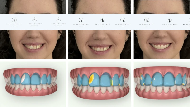 Facette dentaire à Toulouse : révélez un sourire éclatant !