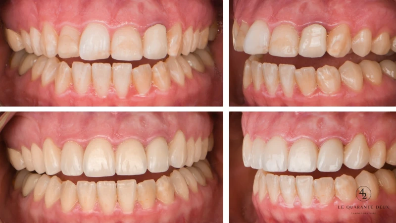 Facette dentaire à Toulouse : révélez un sourire éclatant !