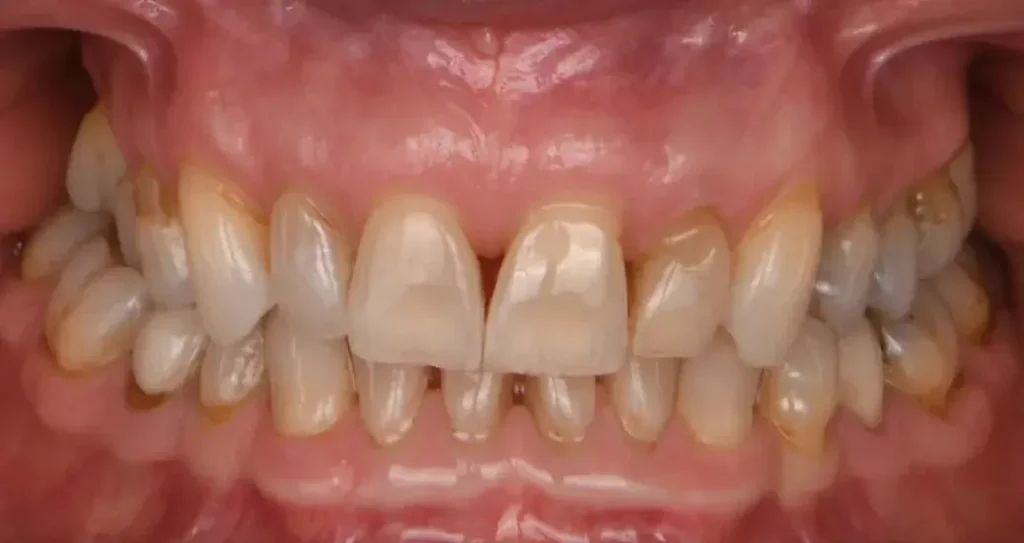 Blanchiment Dentaire à Toulouse